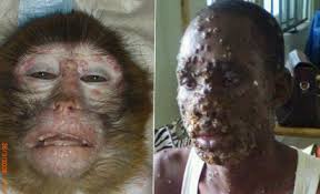 Monkeypox: Nigeria Intensifies Surveillance To Prevent Outbreak