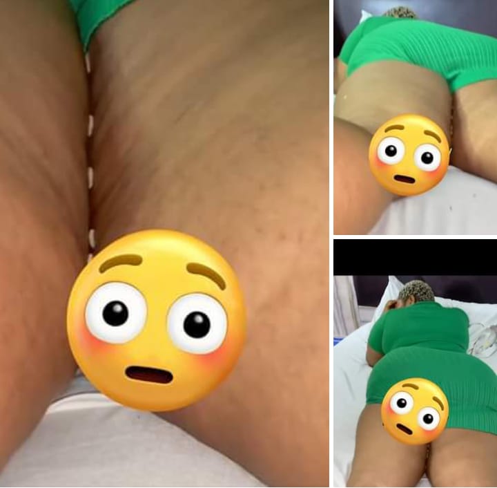 Oh No, This is Pitiable😥:Video Trends As Maggots Coming Out From A Lady’s Private Part After Failed Brazilian Butt Lift (E Don Happen , Watch Video)-Eagle’s Sight News