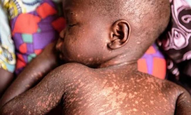 Adamawa Confirms 42 Dead In Measles Outbreak, Shuts All Primary, Secondary Schools